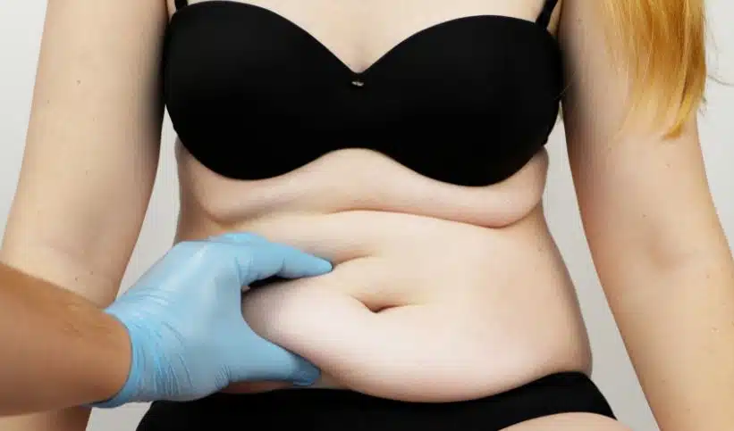 Dans quel cas une abdominoplastie est-elle prise en charge